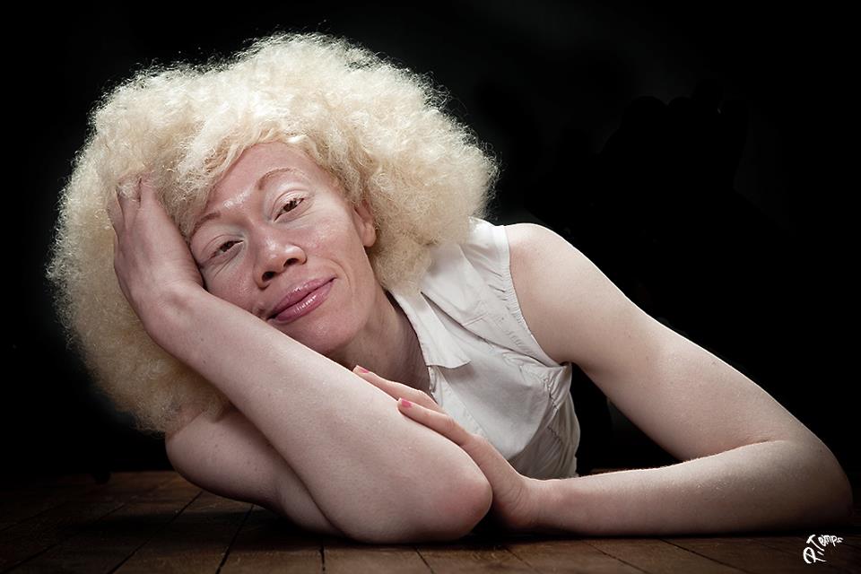 A.N.I.D.A Tous ensemble pour l’albinisme